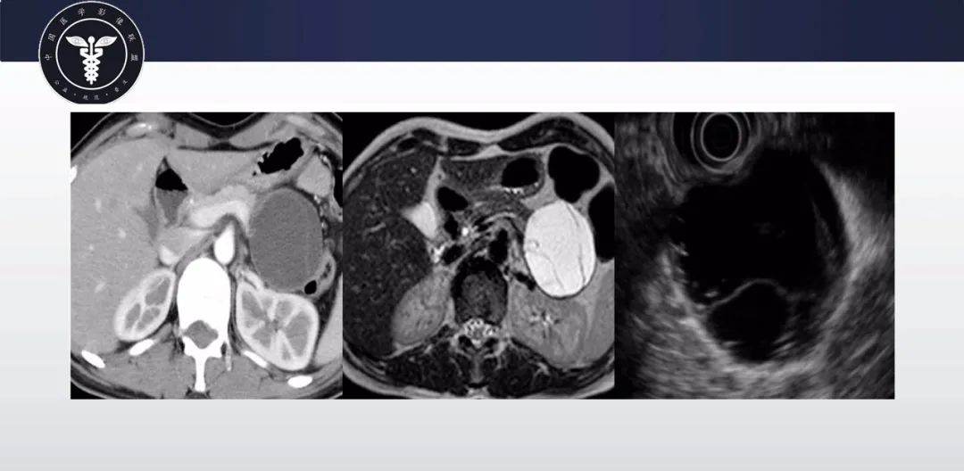 【病例】胰腺血管瘤1例CT及MR影像-12