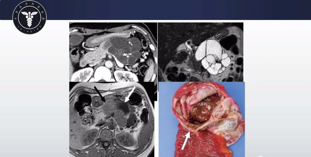 【病例】胰腺血管瘤1例CT及MR影像-13