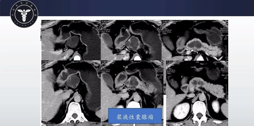 【病例】胰腺血管瘤1例CT及MR影像-9