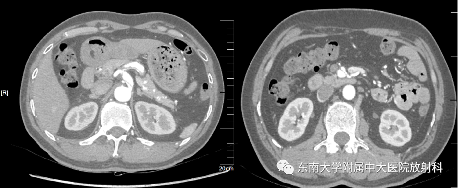 【PPT】肌纤维发育不良-1
