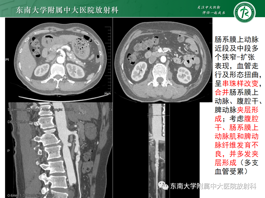 【PPT】肌纤维发育不良-3