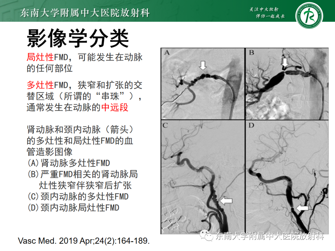 【PPT】肌纤维发育不良-12