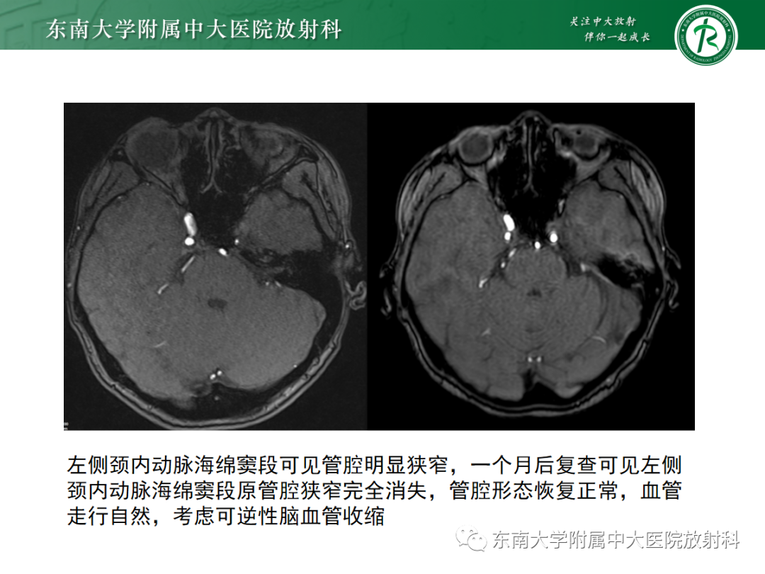 【PPT】肌纤维发育不良-17