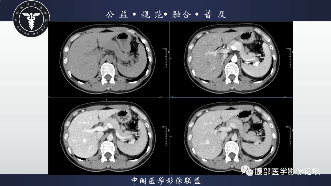 【病例】腹膜后边缘区淋巴瘤1例CT影像-4