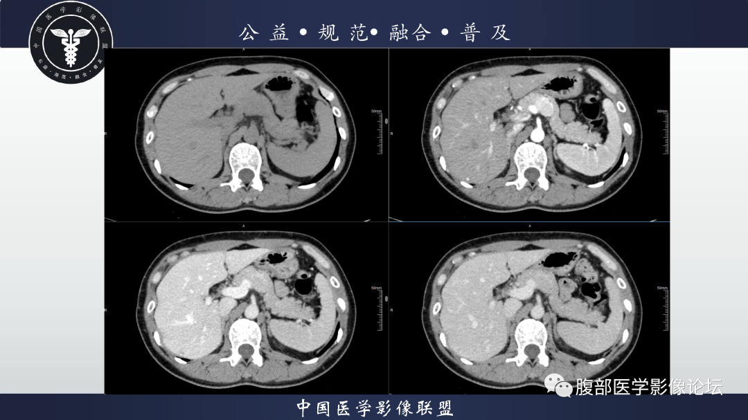 【病例】腹膜后边缘区淋巴瘤1例CT影像-5
