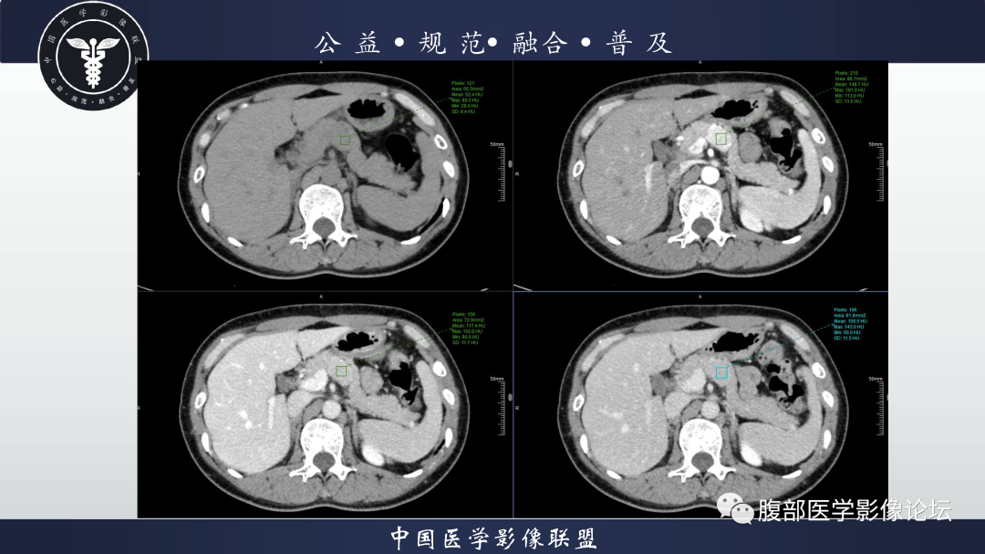 【病例】腹膜后边缘区淋巴瘤1例CT影像-6