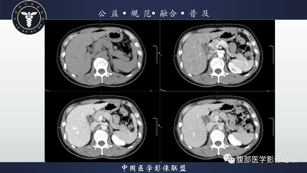 【病例】腹膜后边缘区淋巴瘤1例CT影像-7