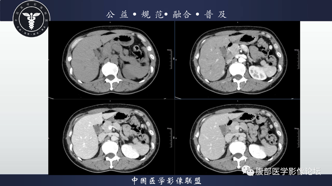 【病例】腹膜后边缘区淋巴瘤1例CT影像-8