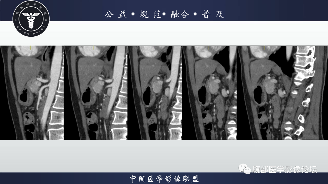 【病例】腹膜后边缘区淋巴瘤1例CT影像-9