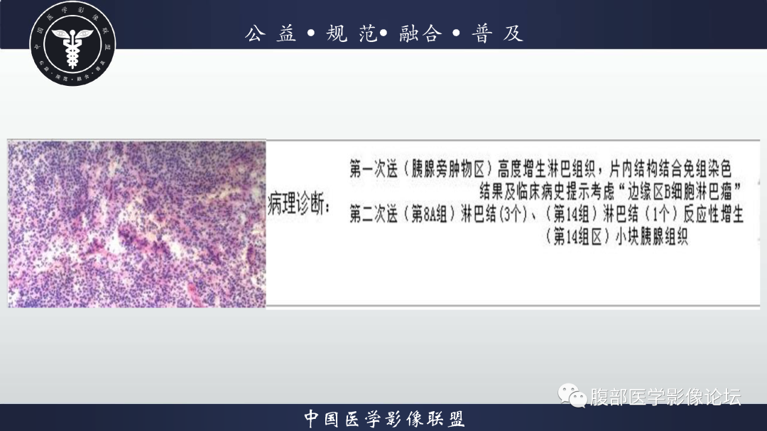 【病例】腹膜后边缘区淋巴瘤1例CT影像-10