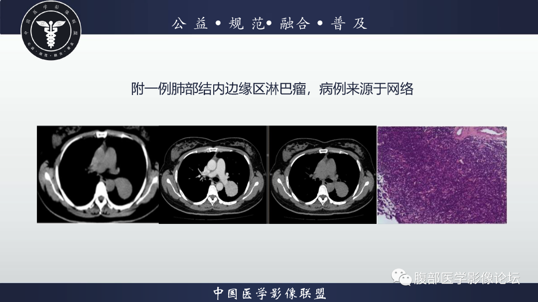 【病例】腹膜后边缘区淋巴瘤1例CT影像-13