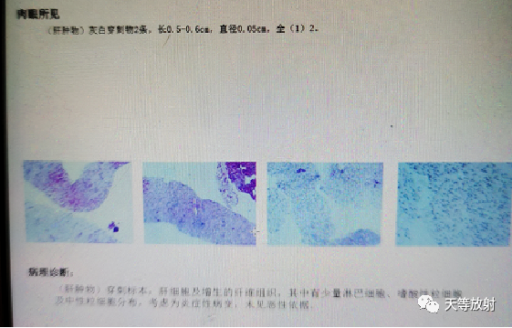【病例】肝脓肿1例CT影像-13