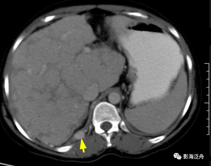 重新认识肝尾状叶-5