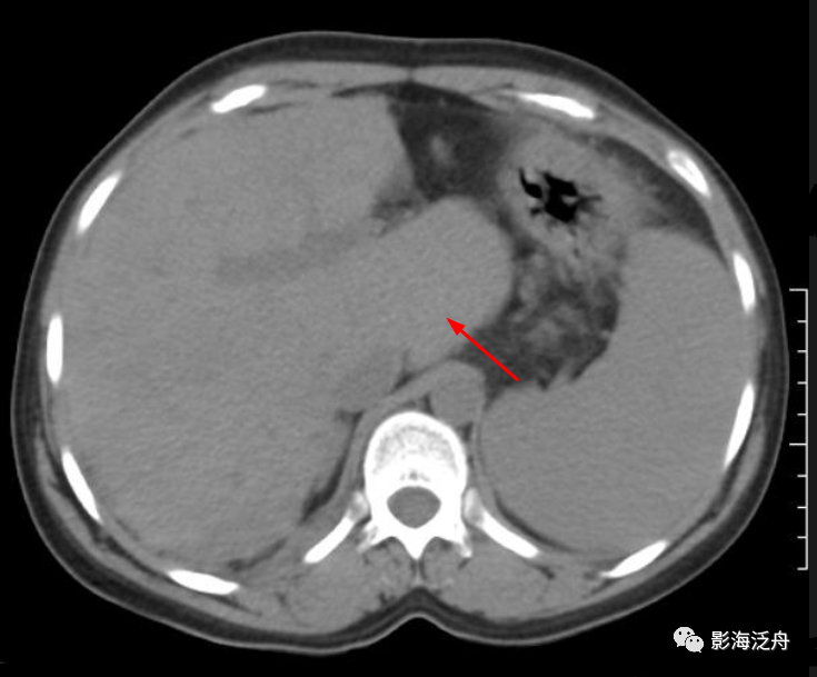 重新认识肝尾状叶-4