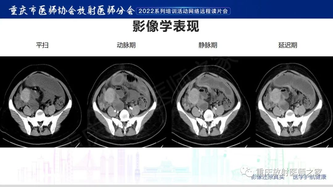 【病例】腹腔纱布异物(纱布瘤)一例CT影像-3