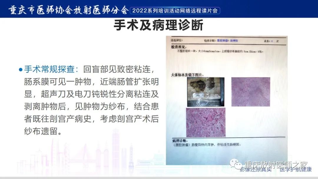 【病例】腹腔纱布异物(纱布瘤)一例CT影像-9