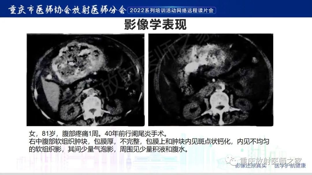 【病例】腹腔纱布异物(纱布瘤)一例CT影像-14