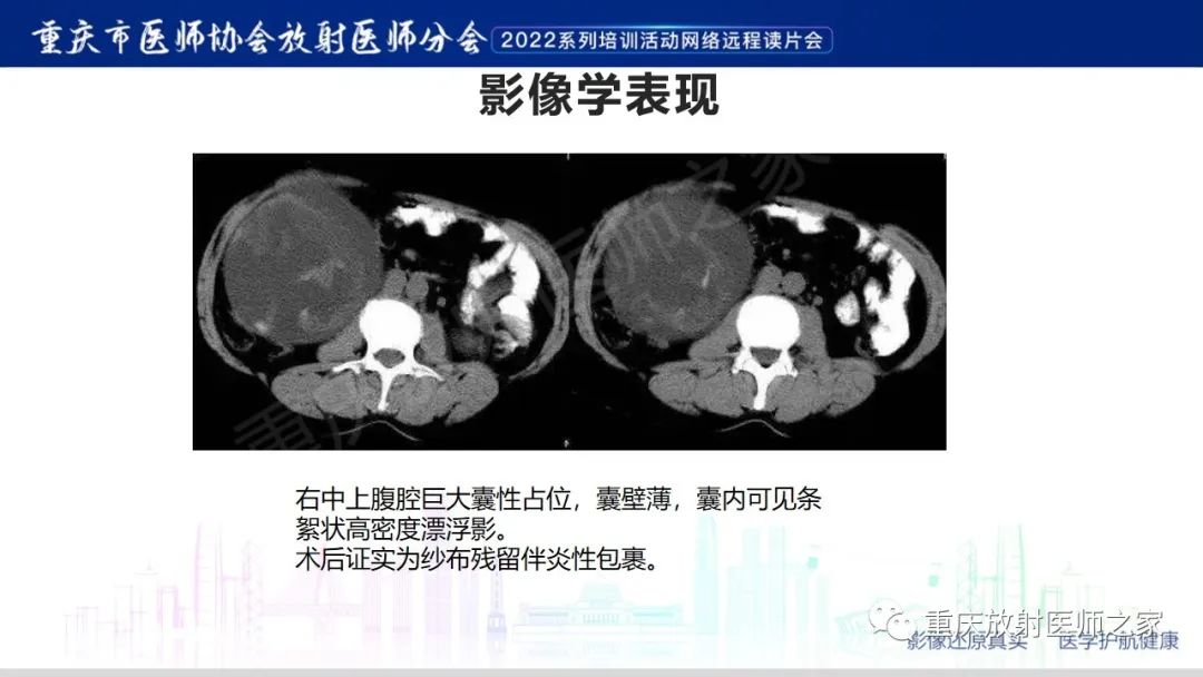 【病例】腹腔纱布异物(纱布瘤)一例CT影像-15