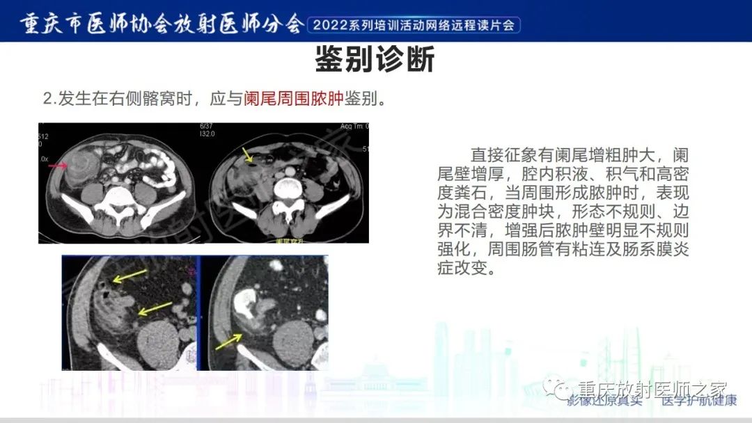 【病例】腹腔纱布异物(纱布瘤)一例CT影像-17