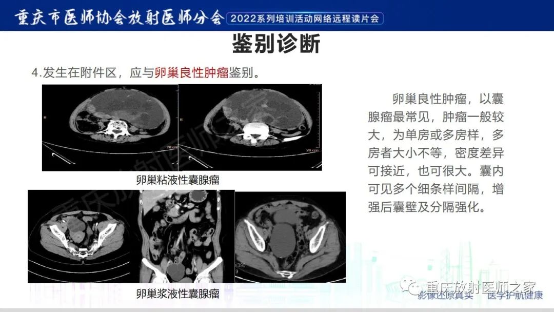 【病例】腹腔纱布异物(纱布瘤)一例CT影像-19