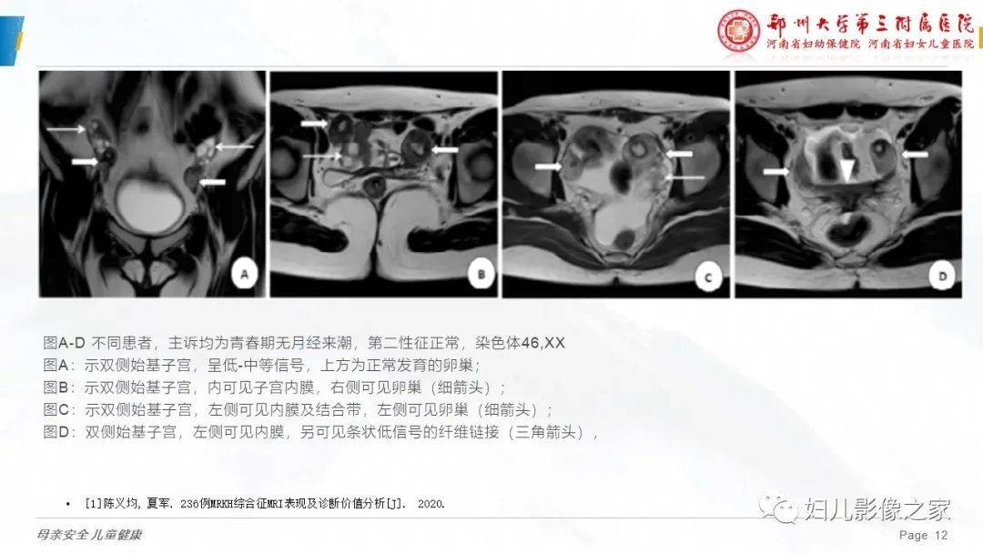 【病例】先天性阴道闭锁1例MR影像-23