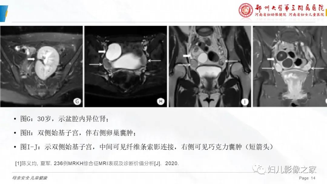 【病例】先天性阴道闭锁1例MR影像-25