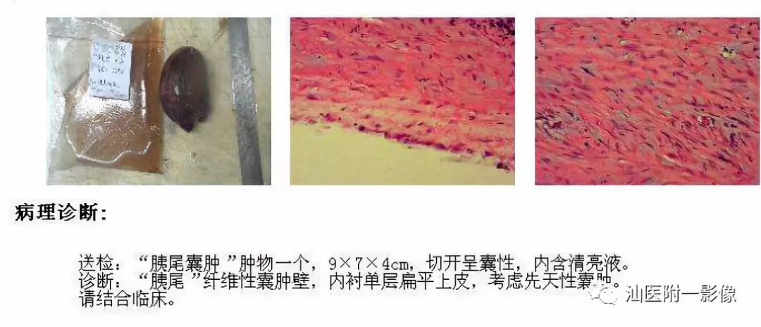 【病例】胰腺真性囊肿 VS 假性囊肿-25