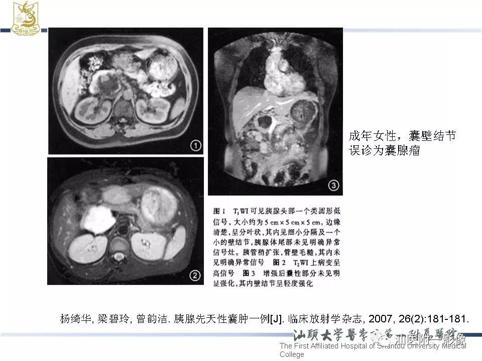 【病例】胰腺真性囊肿 VS 假性囊肿-33