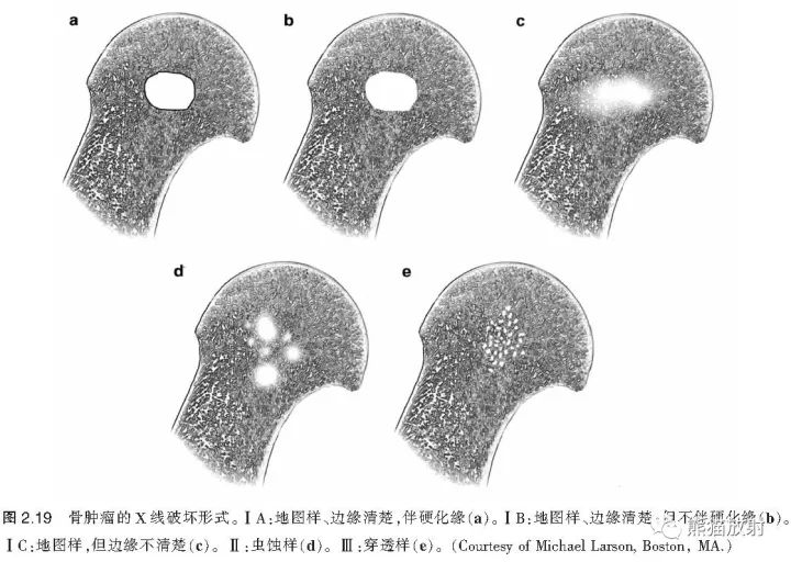 如何评估骨病变——骨破坏的形式和病变的边缘