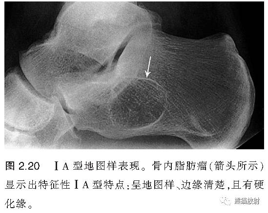 如何评估骨病变——骨破坏的形式和病变的边缘