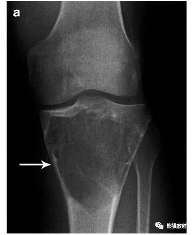 如何评估骨病变——骨破坏的形式和病变的边缘