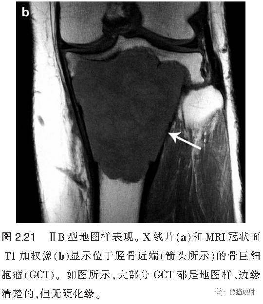 如何评估骨病变——骨破坏的形式和病变的边缘