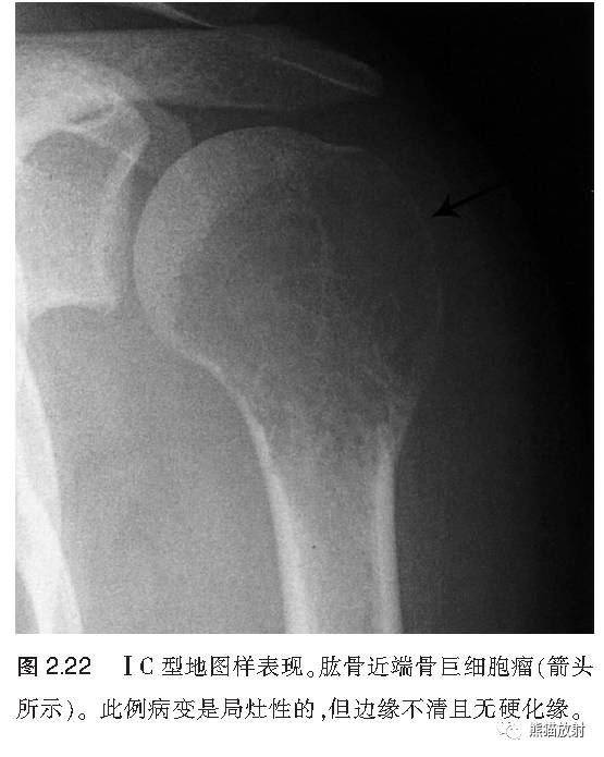 如何评估骨病变——骨破坏的形式和病变的边缘