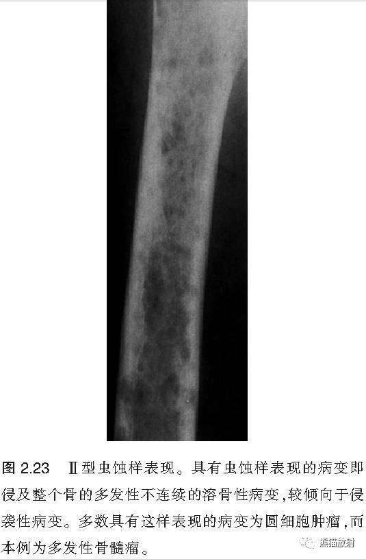 如何评估骨病变——骨破坏的形式和病变的边缘