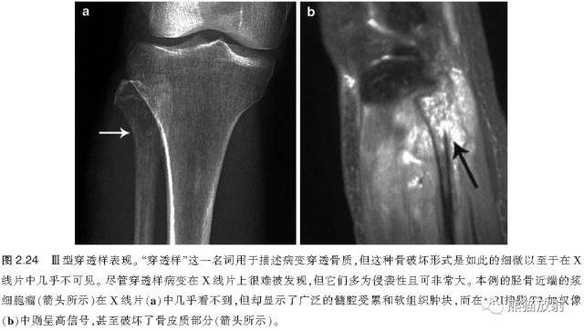如何评估骨病变——骨破坏的形式和病变的边缘