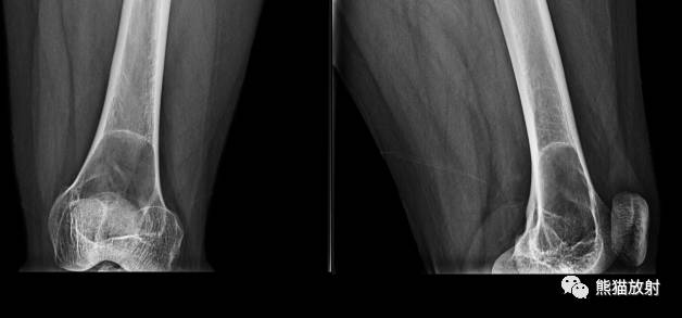 如何评估骨病变——骨破坏的形式和病变的边缘