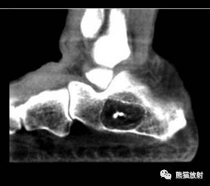 如何评估骨病变——骨破坏的形式和病变的边缘