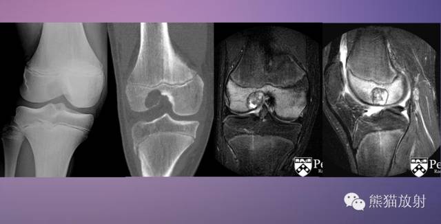 如何评估骨病变——骨破坏的形式和病变的边缘
