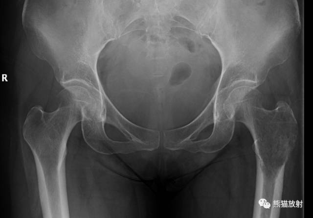 如何评估骨病变——骨破坏的形式和病变的边缘