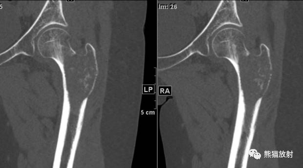 如何评估骨病变——骨破坏的形式和病变的边缘