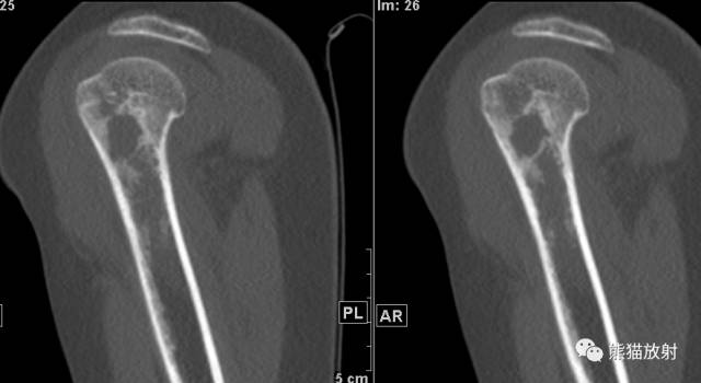 如何评估骨病变——骨破坏的形式和病变的边缘