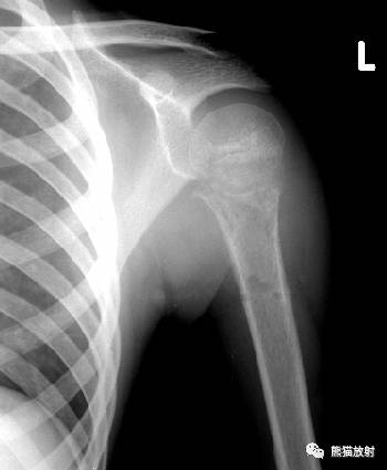 如何评估骨病变——骨破坏的形式和病变的边缘