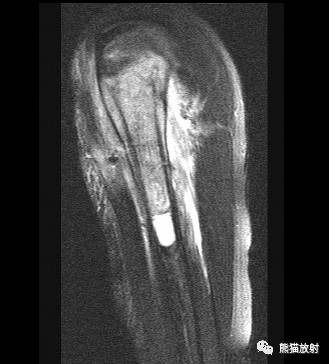 如何评估骨病变——骨破坏的形式和病变的边缘