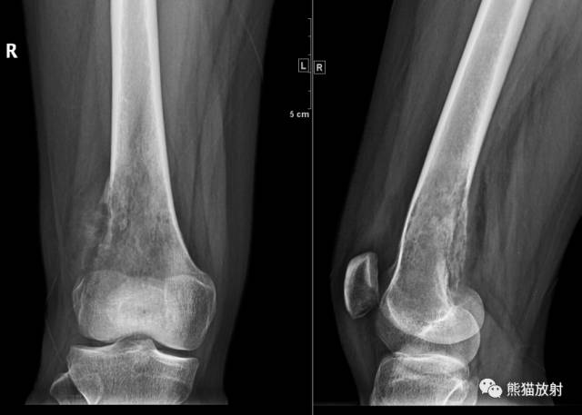 如何评估骨病变——骨破坏的形式和病变的边缘