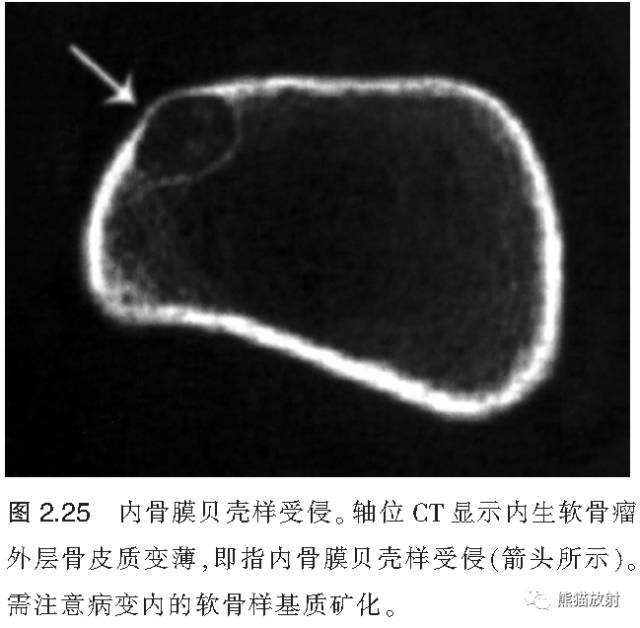 如何评估骨病变——骨破坏的形式和病变的边缘