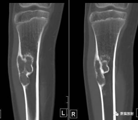 如何评估骨病变——骨破坏的形式和病变的边缘