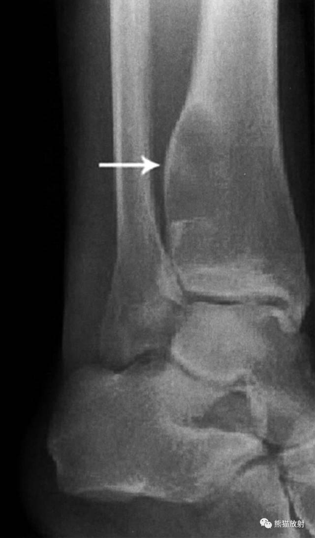 如何评估骨病变——骨破坏的形式和病变的边缘