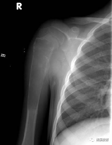 如何评估骨病变——骨破坏的形式和病变的边缘