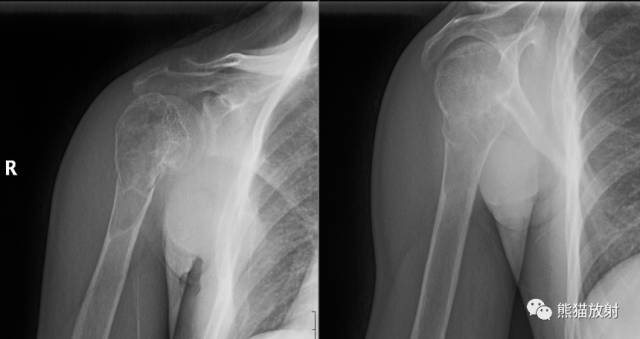 如何评估骨病变——骨破坏的形式和病变的边缘