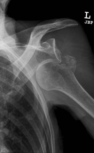 38种特殊类型的骨折